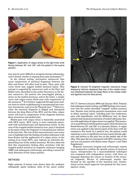 kku compression test|The Trapped Medial Meniscus Tear .